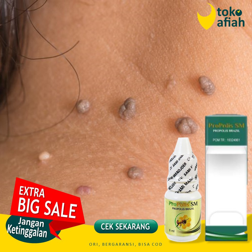 Jual Obat Kutil di Leher, Wajah, Obat Skin Tag Daging Tumbuh Jadi di Kulit  Selangkangan Propolis SM | Shopee Indonesia