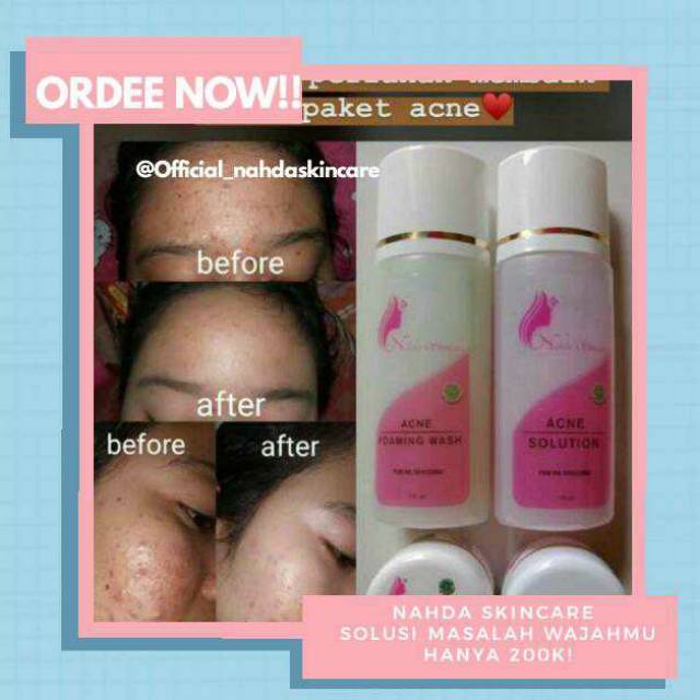 Nahda deals skincare acne